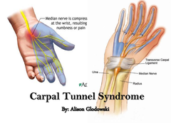 Carpal Tunnel