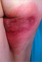 Cellulitis (displaying the four cardinal signs)