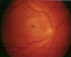 Central Retinal Artery Occlusion