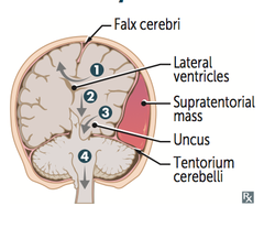 Cerebellar Tonsillar Herniation into the Foramen Magnum