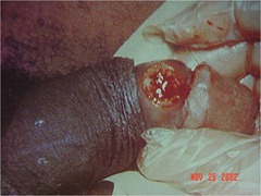 Chancre in Primary Syphilis (Note that the *chancre caused by Treponema pallidum is painless*, whereas the *chancroid caused by Haemophilus ducreyi is painful*.)