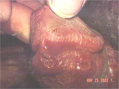 Chancroid (This is caused by Haemophilus ducreyi, and should be differentiated from the chancre of primary syphilis, as caused by Treponema pallidum.)