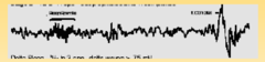 Characteristics of Stage 2 sleep EEG