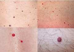 Emory PA - Dermatology Module - Flashcards | StudyHippo.com