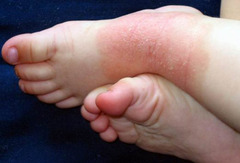 Child Eczema