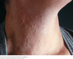 Cholinergic urticaria   Small urticarial papules on neck occurring within 30 min of vigorous exercise. Papular urticarial lesions are best seen under side lighting.  Fitzpatrick Figure 14-10