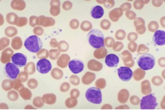 chronic lymphocytic leukemia