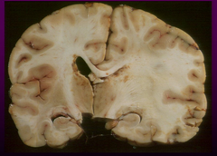 Cingulate [Subfalcine] Herniation under Falx Cerebri
