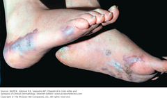 Classic Kaposi sarcoma of the feet   Brownish to blue nodules and plaques, partially hyperkeratotic on the soles and lateral aspects of the feet.  Fitzpatrick's 7e FIGURE 21-18