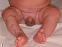 CMTC hypoplasia vascular malformations