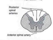 Complete Occlusion of Anterior Spinal Artery