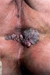Condyloma (genital warts)