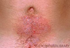 Contact dermatitis  Common triggers: plants (poison ivy, oak), nickle, perfumes, rubber, synthetic shoe materials