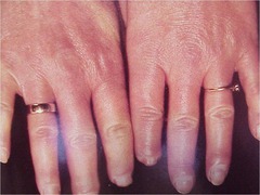 CREST Syndrome: Raynaud's (Calcinosis of skin, Raynaud's, Esophageal dysmotility, Sclerodactaly, Telangiectasias; *positive for ANA, anti-centromere, negative for Scl-70.*)