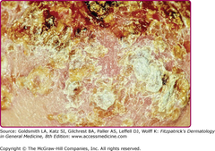 Crusted scabies  Crusted scabies. Close-up showing erosions, lakes of pus, scales, and crusts.  Figure 208-3.2