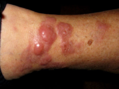 Cutaneous B cell lymphoma