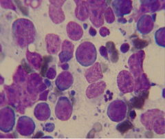 cytology of lymphoma