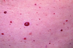 Define Cherry Angioma