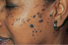 Define Dermatosis Papulosa Nigra