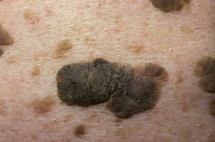 Define Seborrheic Keratoses