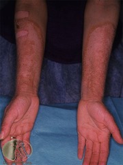 Dermatitis of Pellagra