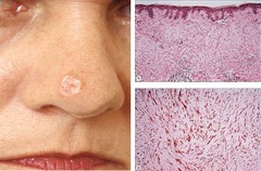 Desmoplastic melanoma