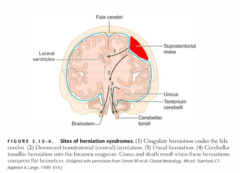 Downward Transtentorial [Central] Herniation