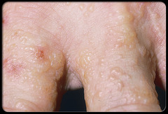 Dyshidrosis (AKA pomphylx; hand dermatitis, vesiculobullous dermatitis of the palms and soles)