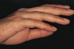 Dyshidrosis (hand eczema)