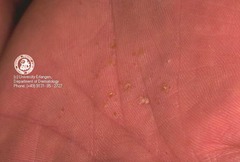 Dyshidrosis is treated with:  Burrows solution (Domeboro) Topical high potency steroids Antibiotic Tx for infection Systemic steriods Intralesional Triamcinolone  (Marlin D&E Lecture PP51;53)