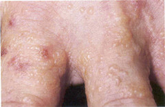 Dyshidrotic dermatitis