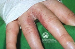 Dyshidrotic Eczema  Complication- secondary bacterial infection W Staph  (Marlin D&E Lecture PP48;51)