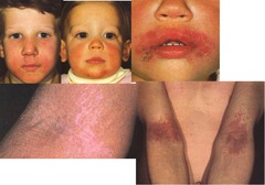 Eczema (Atopic dermatitis)