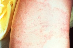 Eczema (Appearance is classically more ill-defined scaly erythematous coalescing papules and plaques; *childhood form favors flexors; often lichenified*; 40% have persistent disease as adults)