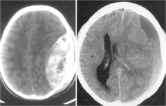 Epidural hematoma CT brain