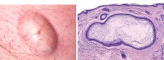 Epithelial Inclusion Cyst