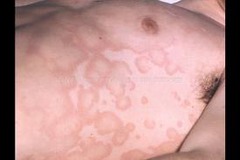 erythema marginatum