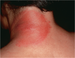 Erythema migrans (*Caused by Borrelia burgdorferi transmitted by Ixodes*, treat with doxycycline, amoxicillin, or ceftriaxone)