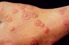 Erythema multiforme with genital HSV  Usually assc with new HSV infection, can also see with mycoplasma infection