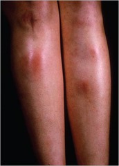 Erythema Nodosa (Causes: Strep, OCPs, Pregnancy, or idiopathic)