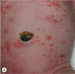 Erythema Toxicum Neonatorum; eos; subcorneal pustule with eos (ass with pilosebaceous unit)