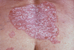 Erythematous scaly plaque. Well demarcated, annularish