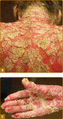 Erythrodermic psoriasis.   The patient shown in panels B and C had total body involvement with marked hyperkeratosis and desquamation.   Fitzpatrick's Figure 18-13