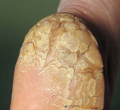Fissure (secondary lesion)