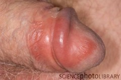 Fixed drug eruption  Same rash every time  Frequently in the genital region