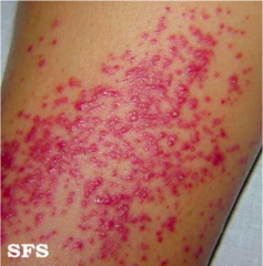 Folliculitis.  Pathogenesis: infection, occlusion, irritation, skin disease.