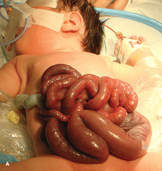 Gastroschisis will see high maternal AFP Not usually associated w/ other d/o Complications: May be atretic or necrotic req removal. Short gut syndrome