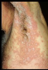generalized pustular psoriasis with lakes of pus