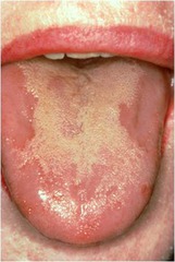 Geographic tongue (Occurs after eating hot foods or drinking hot beverages; benign finding that will heal.)