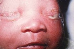 Gonococcal conjunctivitis tx w/ topical erythromycin and IV 3rd gen ceph.